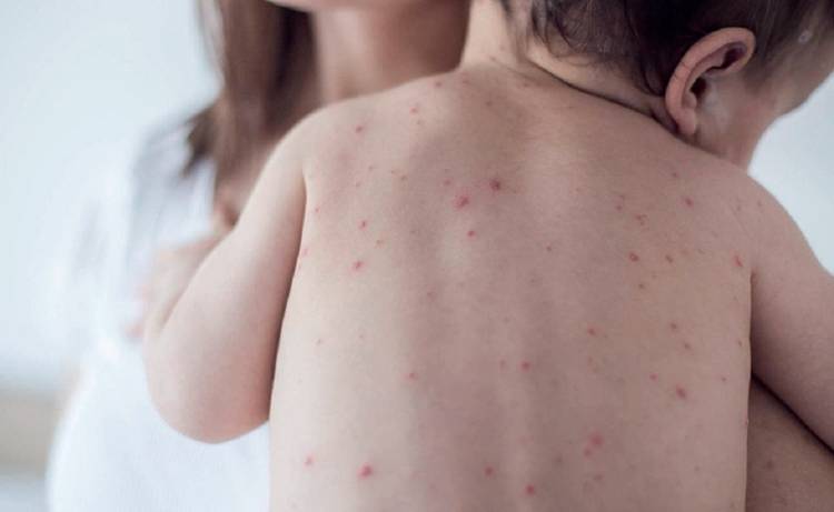 El ministerio de Salud emitió un alerta epidemiológica por nuevos casos de sarampión